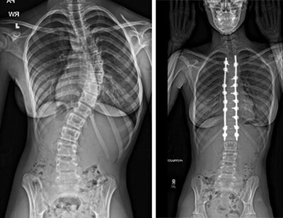 Left: X-ray of a child from the shoulders to the pelvis showing an S-shaped spinal curve. Right: X-ray of a child from the head to the pelvis after surgery that made their spine straighter