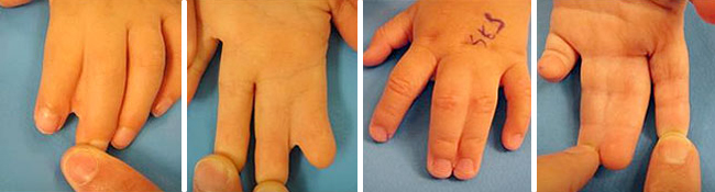 Syndactylyhttp://www.seattlechildrens.org/uploadedImages/Seattle_Childrens/Medical_Conditions/Bone,_Joint_and_Muscle_Conditions/Hand_and_Arm_Differences/syndactyly-Quadriptych.jpg
