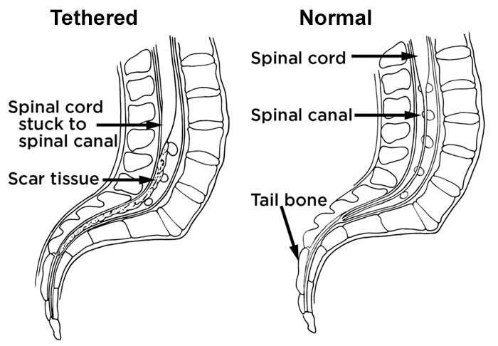 tethered spinal cord full tethered spinal cord full