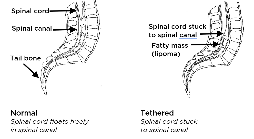 Tethered Spinal Cord - Seattle Children's