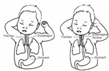 (Left illustration) Normal anatomy. (Right illustration) Esophageal atresia (EA) with distal tracheoesophageal fistula (TEF).