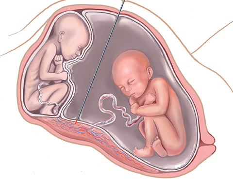 Illustrations showing a laser being used to treat twin-to-twin transfustion syndrome.