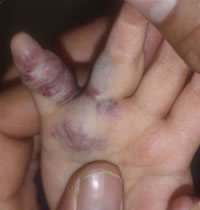 Venous malformations in the hand.