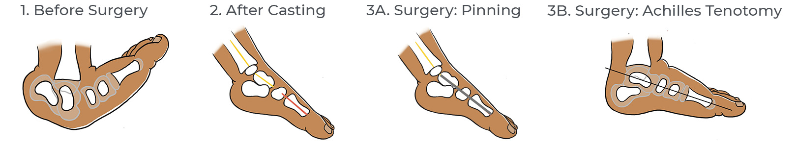 Illustration of the stages of vertical talus surgery