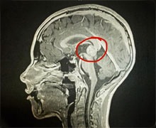 Roarke's brain tumor