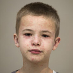 A boy with measles