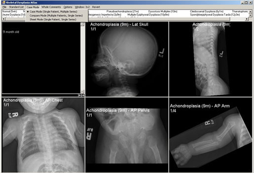 Achondroplasia case is shown in 