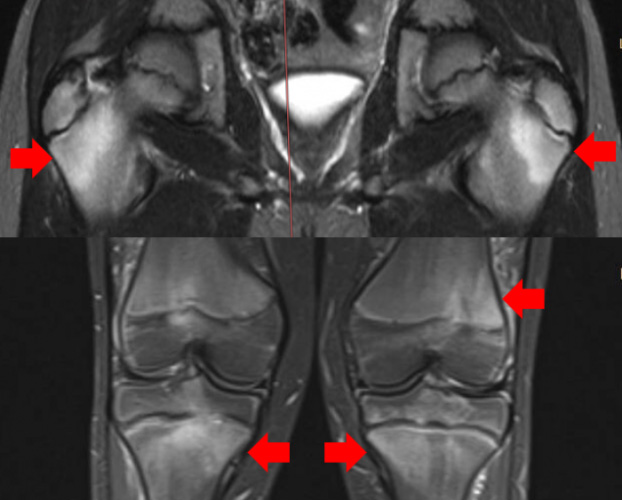X-rays of CRMO patient