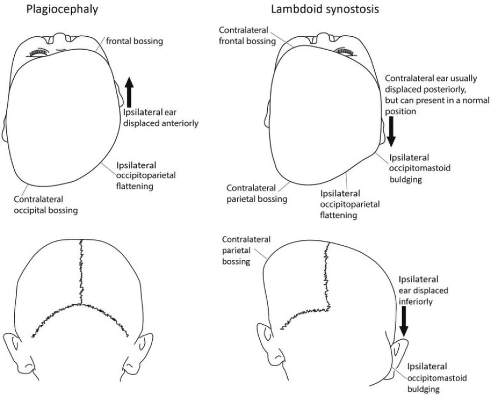 Illustration of the differences between plagiocephaly and craniosynostosis.