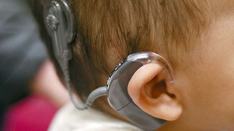 Early Referral Matters: From Hearing Evaluation to Cochlear Implant Care