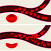 An illustration showing blood cells becoming stuck in a blood vessel