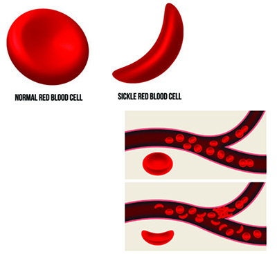 An illustration showing blood cells becoming stuck in a blood vessel