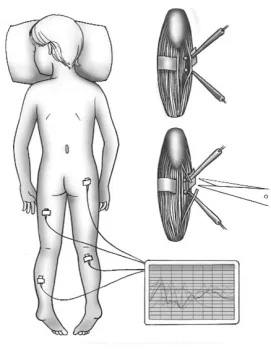 A diagram of hypertonia surgery