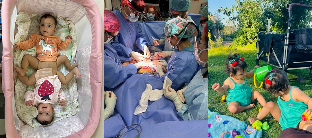Two babies conjoined at the pelvis lay in a crib (left); surgeons performing surgery on conjoined twins (middle); two toddlers sit in a park (right)