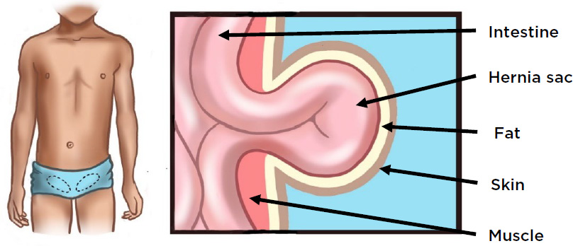 Illustration of an inguinal hernia