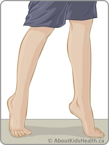 Illustration of Idiopathic toe walking