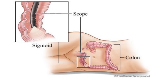 Diagram of the colon, sigmoid and scope