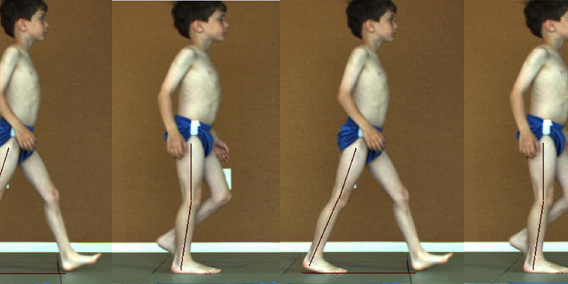 Several images of the same boy in various gait analysis stances