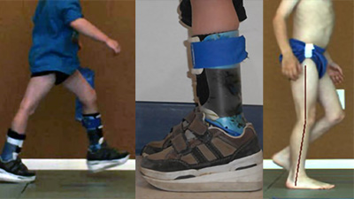 A child in motion, wearing a blue shirt and black ankle-foot orthoses (AFOs) with sneakers (left); A close-up of the child's lower leg and foot inside a black and blue AFO and sneaker (center); a child standing to highlight body alignment, with a red line indicating leg posture and balance (right)