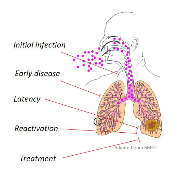 Drawing of human being depicting infection of respiratory system with tuberculosis