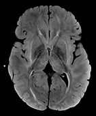 A brain scan