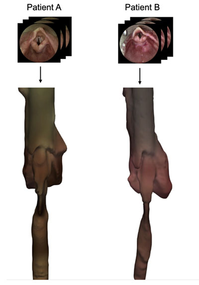 Comparison of Patient A and Patient B Airway passages