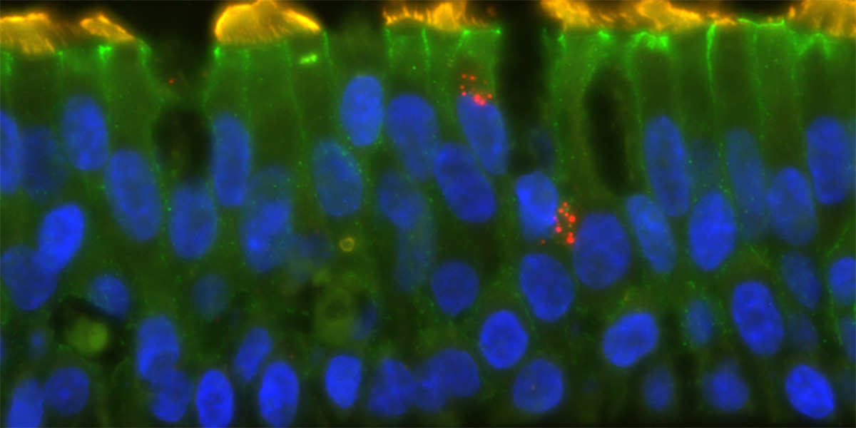 Bronchial cells infected with rhinovirus