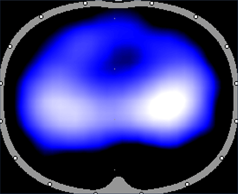 A typical EIT image of healthy lungs.