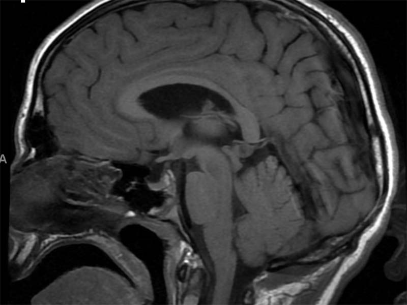 Sleuthing the Source of a New Neurodevelopmental Disorder
