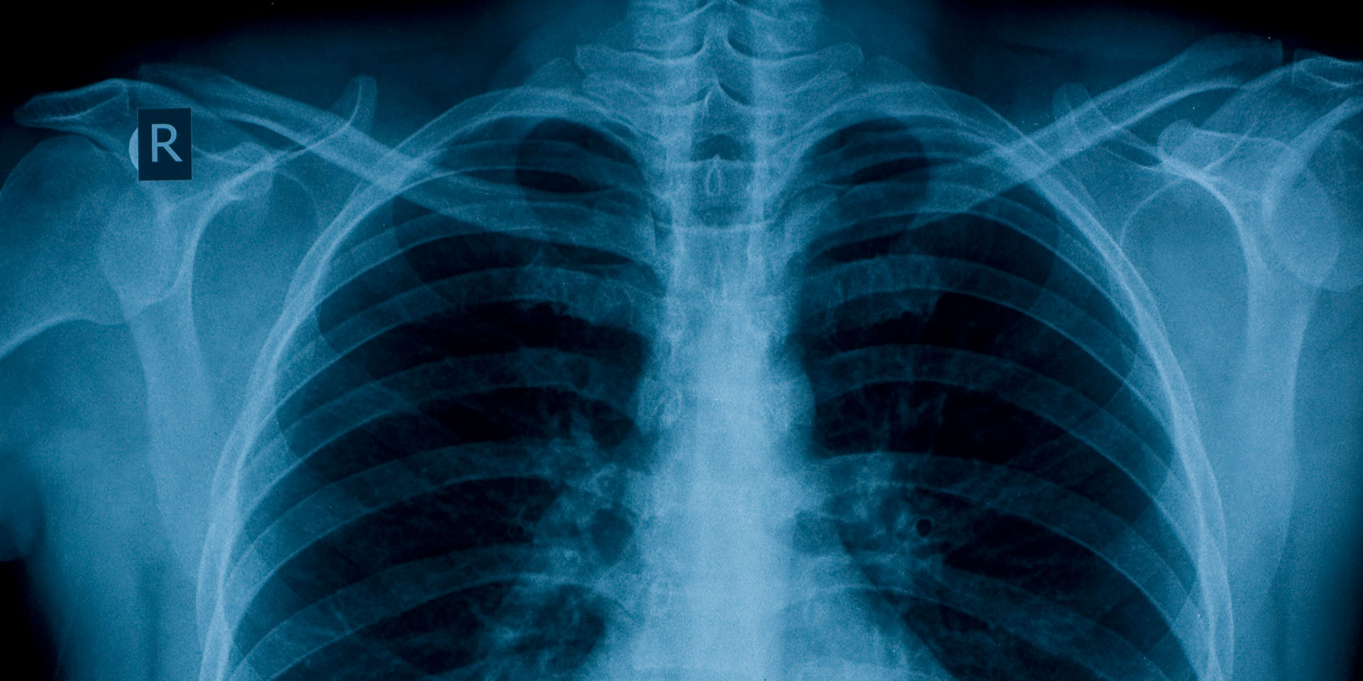 An X-ray of human lungs.