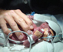 Intubated Baby
